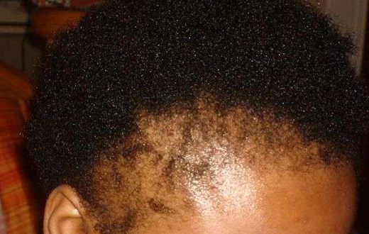 Hair loss