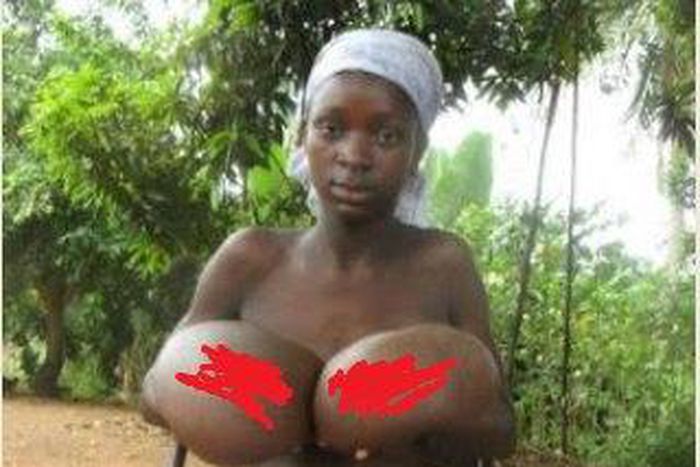 11 year old suffering from hypertrophy