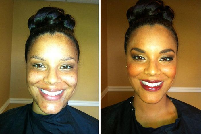 The right (i.e. not bloody) way to remove skin tags