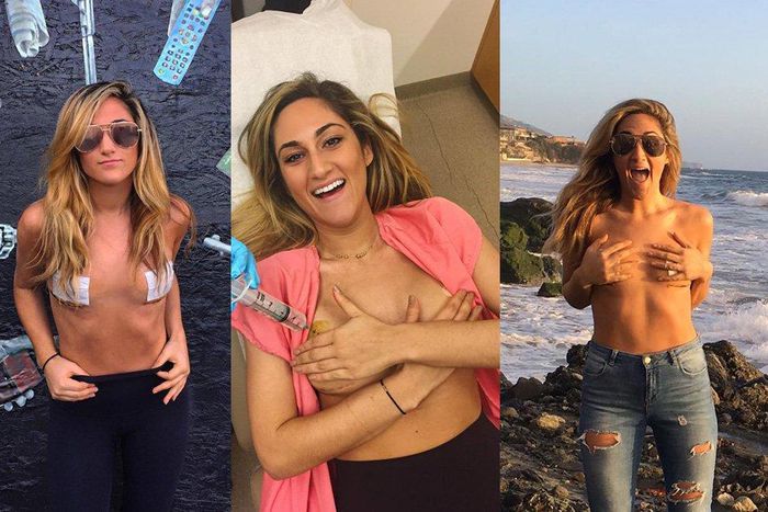 Lady documents her double mastectomy.