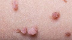 ___6533053___https:______static.pulse.com.gh___webservice___escenic___binary___6533053___2017___4___15___6___gettyimages-157730857-skin-tags-jodi-jacobson