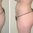 Transfer of belly fat to butt
