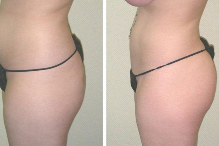 Transfer of belly fat to butt