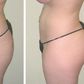 Transfer of belly fat to butt