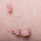 Skin tags
