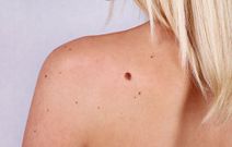 skin cancer
