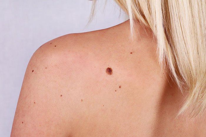 skin cancer causes surprising