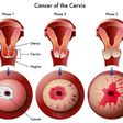 Stages of Cervical Cancer