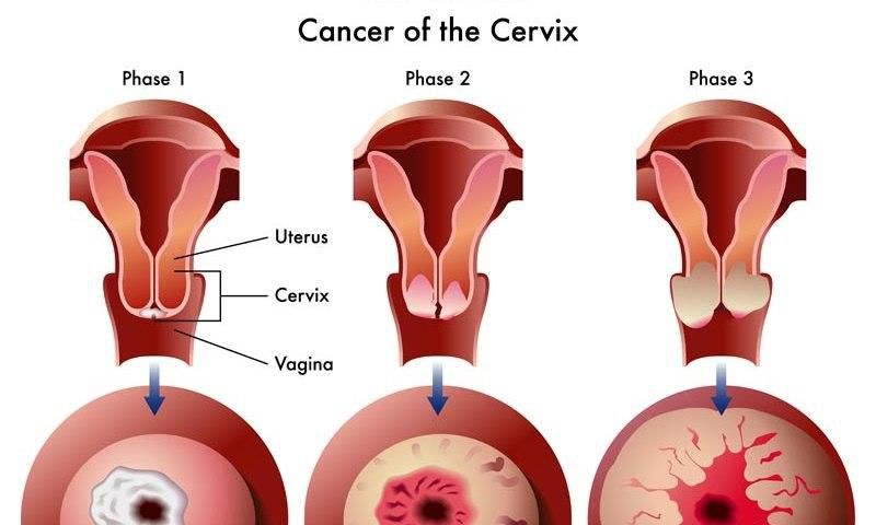 Stages of Cervical Cancer