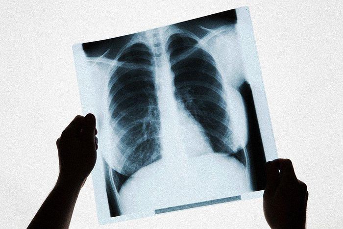 how long you sleep predict lung cancer