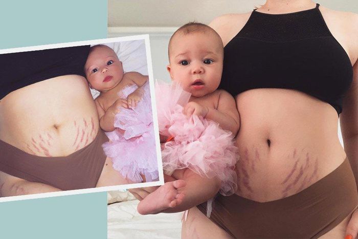 ___6694950___https:______static.pulse.com.gh___webservice___escenic___binary___6694950___2017___5___17___19___stretch-marks-mother