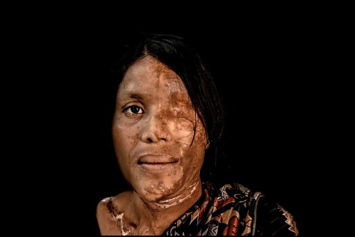 Woman attacked with acid