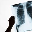 This Is Why Men Need to Be Screened For Lung Cancer More Than Women