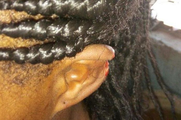 The woman's bitten ear