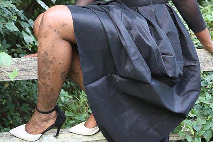 3 women explain what it’s really like to live with ailment