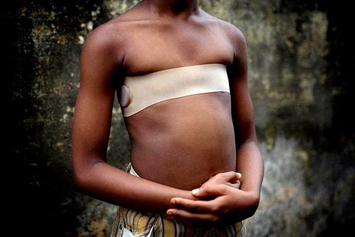 Hundreds of British mums are thought to have 'breast-ironed' their daughters