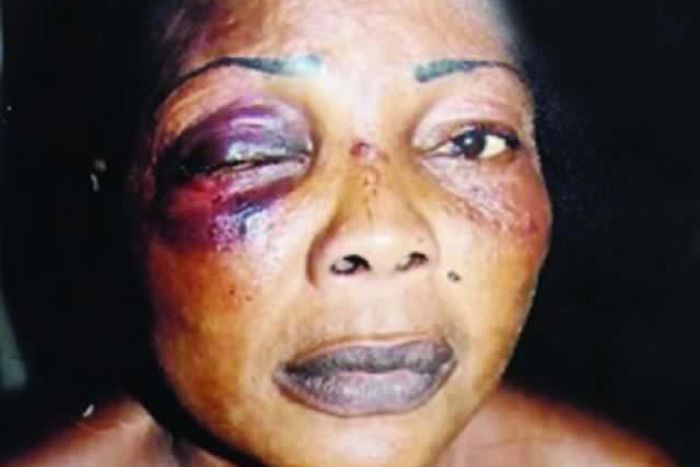 Olasunkanmi Lawal will go through life with one eye