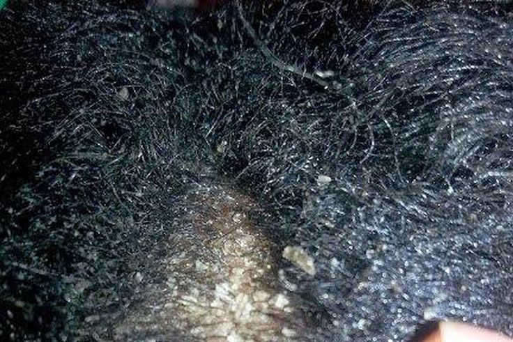 ___4631401___https:______static.pulse.com.gh___webservice___escenic___binary___4631401___2016___2___1___13___dandruff-3