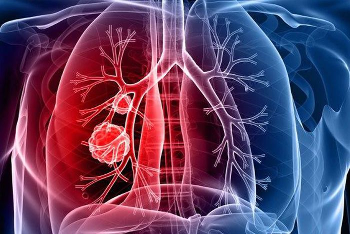 ___4578674___https:______static.pulse.com.gh___webservice___escenic___binary___4578674___2016___1___19___16___Diagnosis-And-Treatment-For-Lung-Cancer