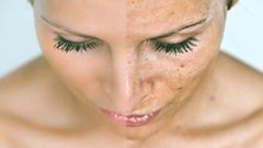 Before and after: Woman with black spots