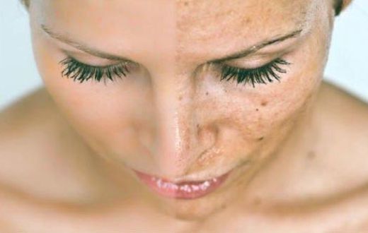 Before and after: Woman with black spots