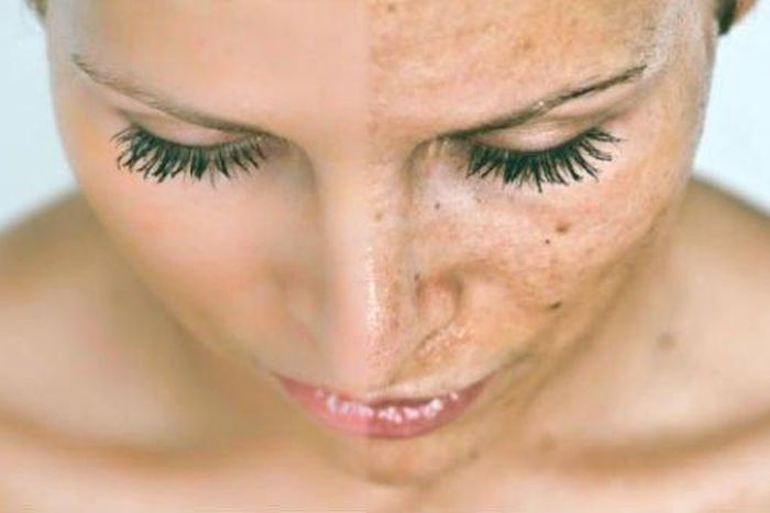 Before and after: Woman with black spots