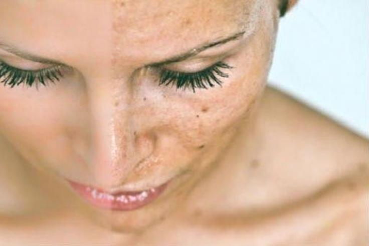 Before and after: Woman with black spots