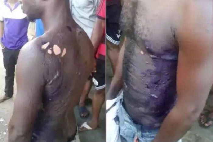 The badly scalded man