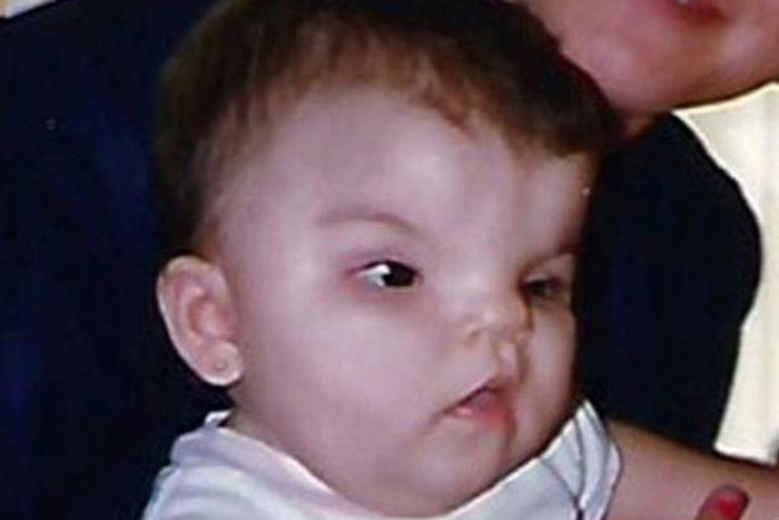 Meet woman born with hole in skull and no Nose