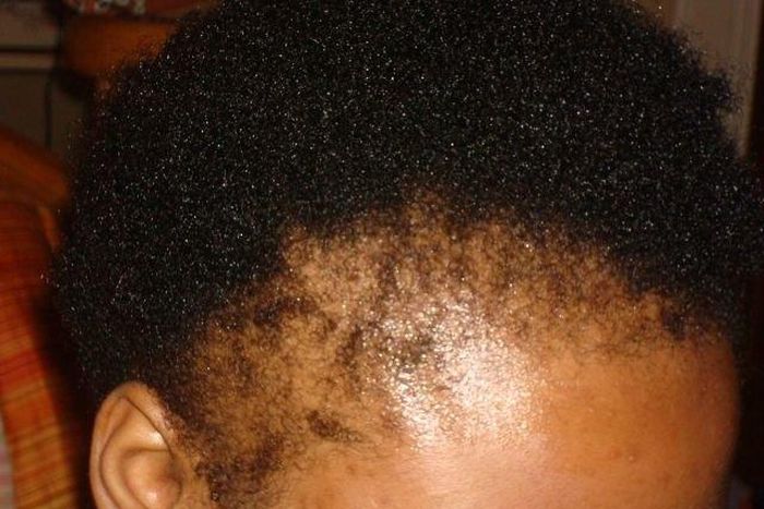 ___4537589___https:______static.pulse.com.gh___webservice___escenic___binary___4537589___2016___1___8___15___traction-alopecia-543