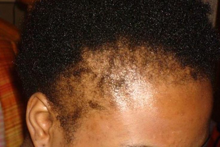 ___4537589___https:______static.pulse.com.gh___webservice___escenic___binary___4537589___2016___1___8___15___traction-alopecia-543