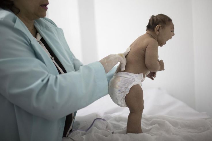 Brazil reports increase in microcephaly cases linked to Zika