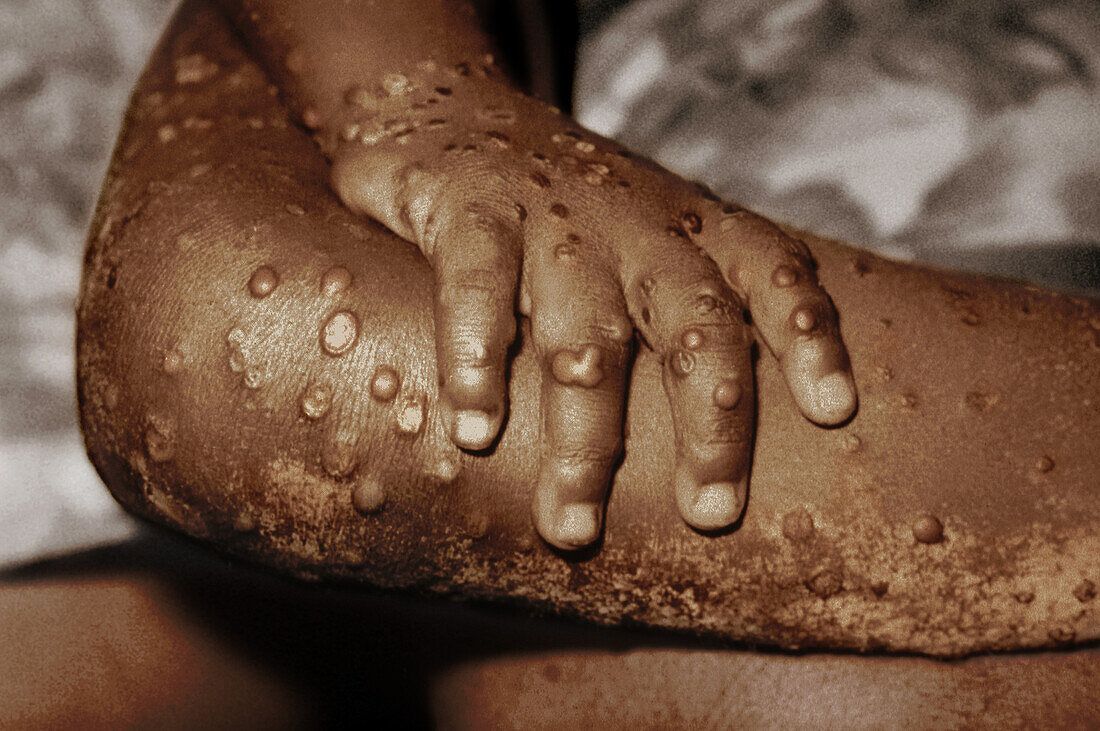 Ghana's Mpox cases soar to 302 as GHS confirms 20 new infections