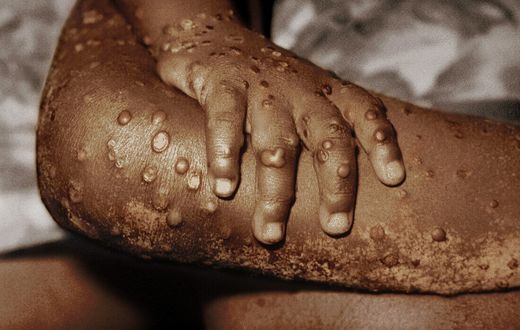 Ghana's Mpox Cases soar to 302 as GHS confirms 20 new infections