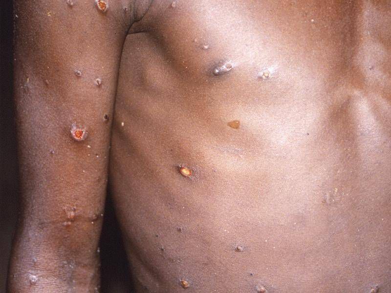 Ghana's Mpox cases soar to 302 as GHS confirms 20 new infections
