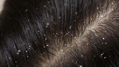 Dandruff