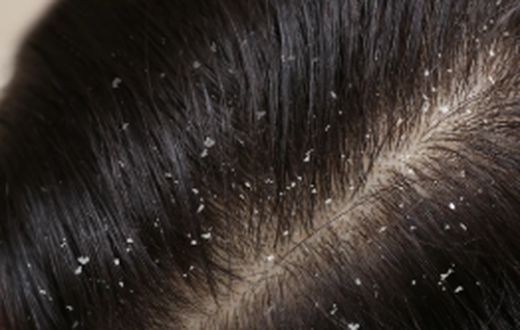 Dandruff