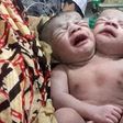 The two headed baby