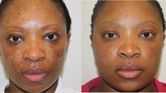 A blemished skin shows improvement after treatment