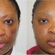 A blemished skin shows improvement after treatment