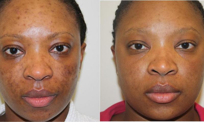 A blemished skin shows improvement after treatment