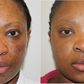 A blemished skin shows improvement after treatment
