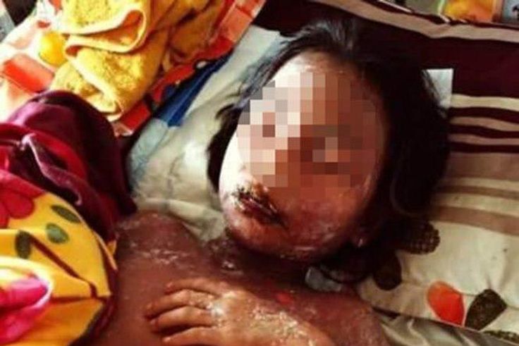 Ho Thi Kieu, 11 year old girl diagnosed with Lyell’s syndrome