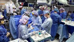 7-weeks old Conjoined twins who shared a heart separated successfully
