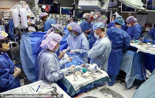 7-weeks old Conjoined twins who shared a heart separated successfully