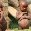Malnourished child