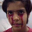 Twinkle, a 13-year-old girl from Indian spontaneously bleeds from her head, hands and feet.