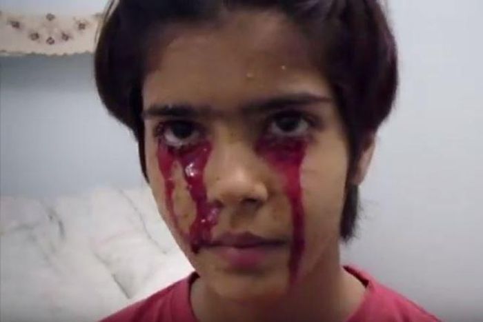 Twinkle, a 13-year-old girl from Indian spontaneously bleeds from her head, hands and feet.