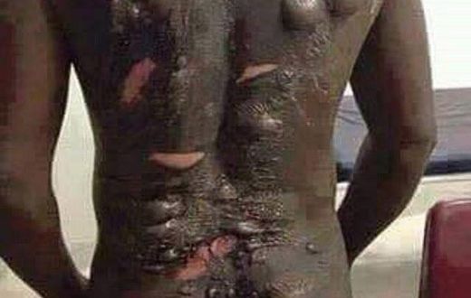 This man was bathed with hot water by his wife