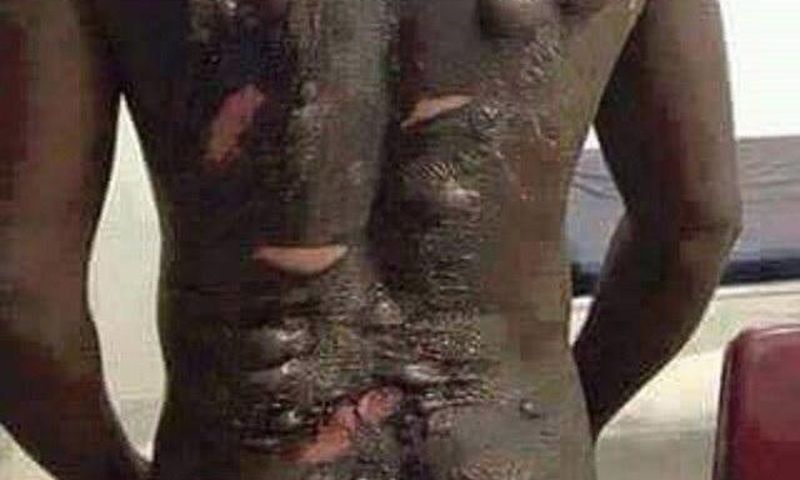 This man was bathed with hot water by his wife